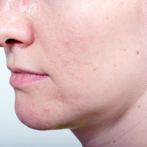 しわ たるみ 福岡市中央区天神でシワとたるみの改善 トータルスキンクリニック 年最新版