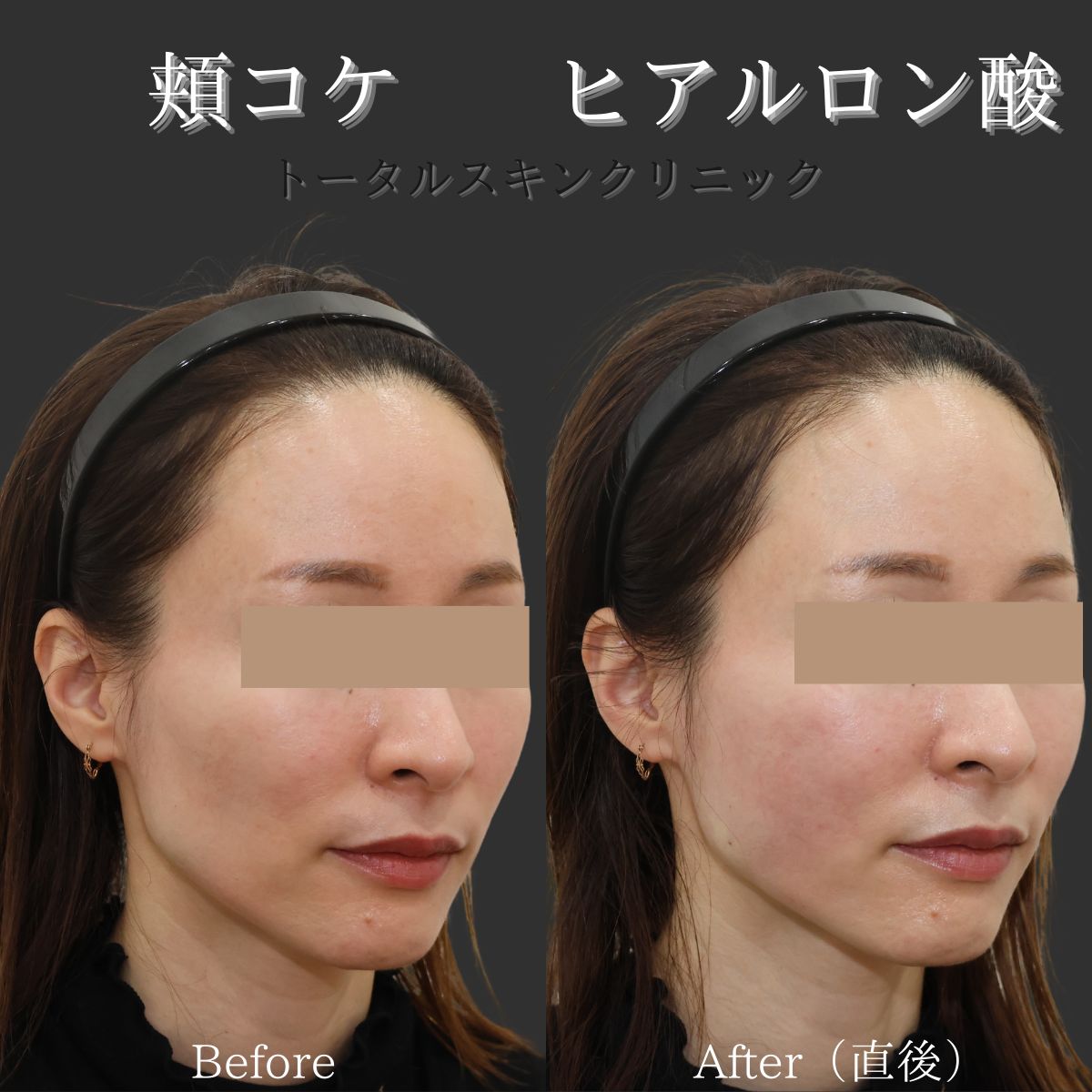 頬こけ ヒアルロン酸 デメリット