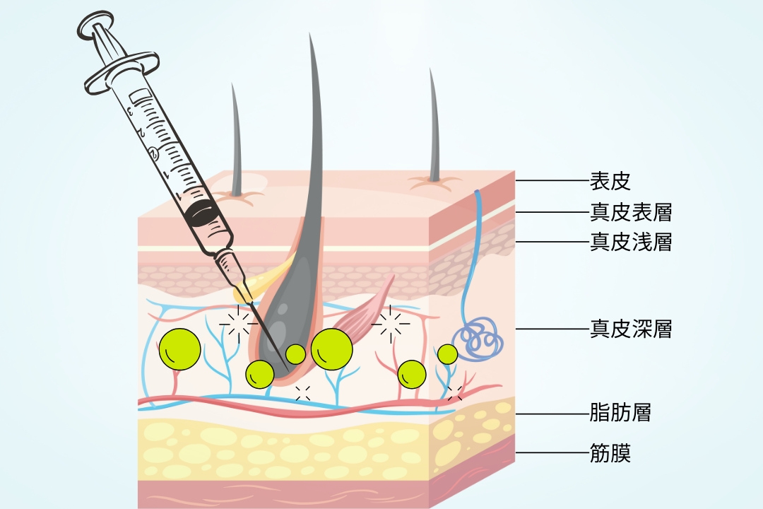 ジュベルックは、浅い層(真皮層)に注入する設計