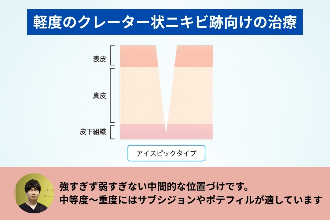 キュアジェットは軽度のクレーター状ニキビ跡向けの治療で、強すぎず弱すぎない中間的な位置づけです。中等度～重度にはサブシジョンやポテフィルが適しています。