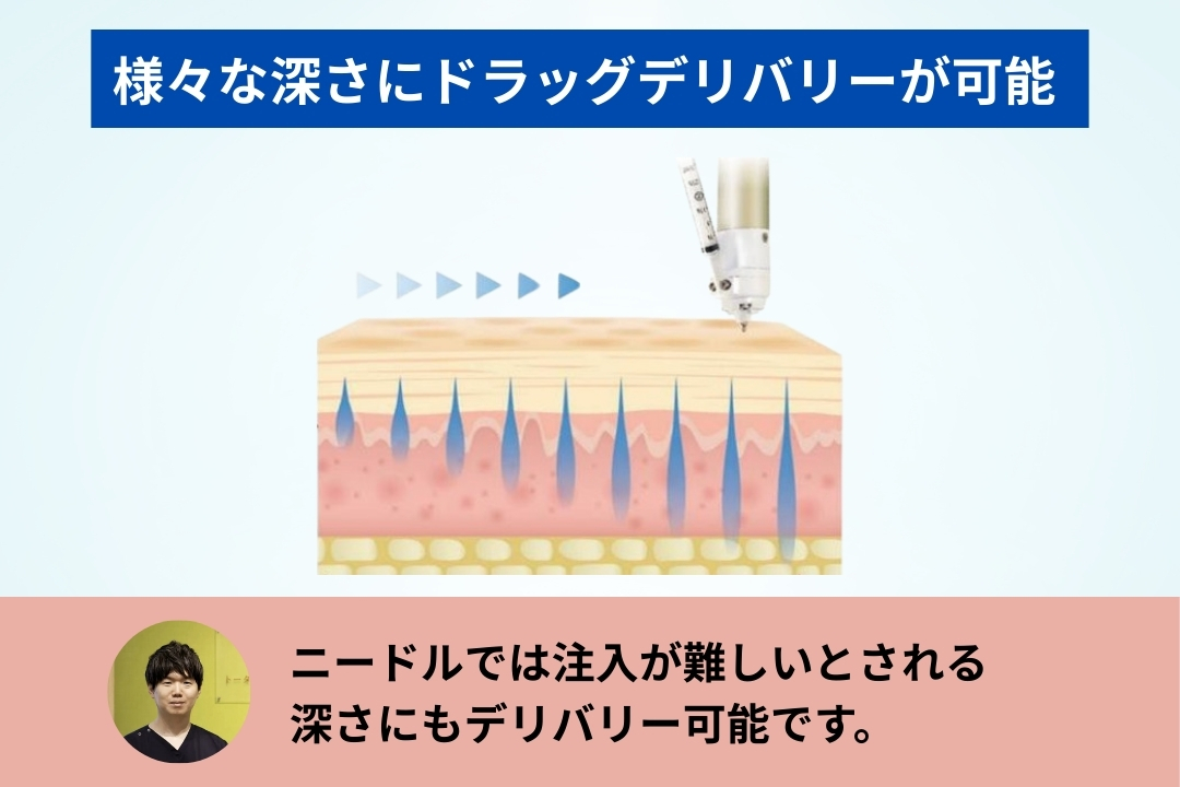 【キュアジェットは様々な深さにドラッグデリバリーが可能 】
ニードルでは注入が難しいとされる
深さにもデリバリー可能です。