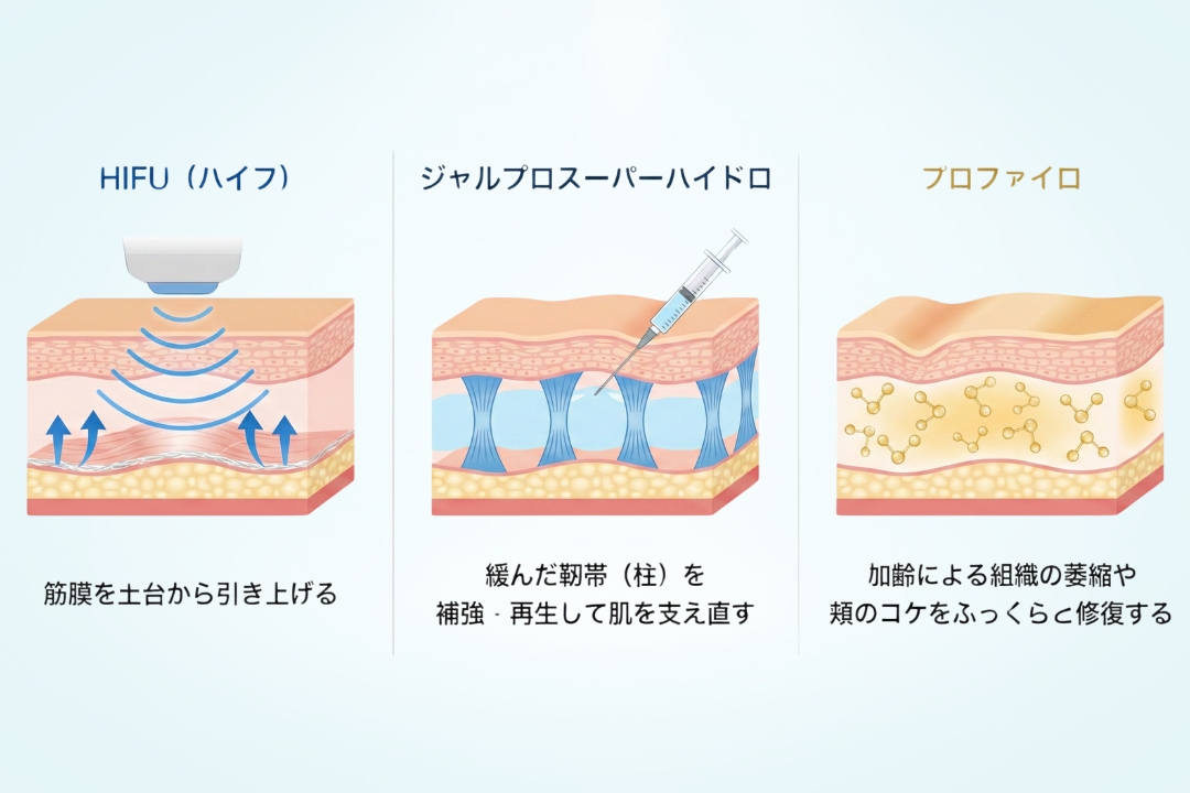 ・HIFU(ハイフ)
筋膜を土台から引き上げる
・ジャルプロスーパーハイドロ
緩んだ靭帯(柱)を補強・再生して肌を支え直す
・プロファイロ
加齢による組織の萎縮や頬のコケをふっくらと修復する