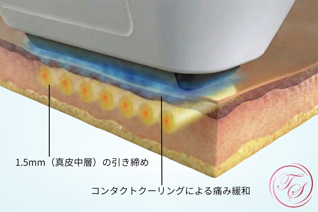ソフウェーブ(sofwave)は・1.5mm(真皮中層)の引き締め
・コンタクトクーリングによる痛み緩和