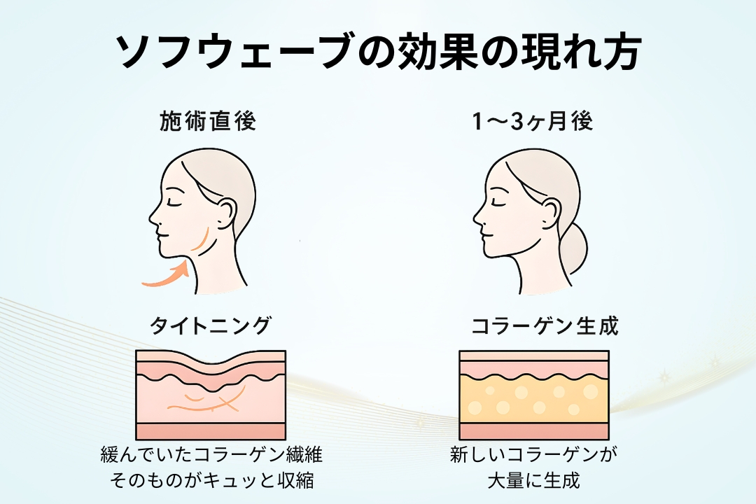 「ソフウェーブの効果の現れ方」 ・施術直後(一次効果): 熱エネルギーが加わることで、緩んでいたコラーゲン繊維そのものがキュッと収縮(タイトニング) ・1〜3ヶ月後(二次効果)新しいコラーゲンが大量に生成