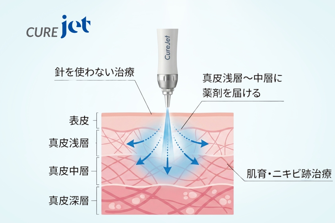 キュアジェット｜針を使わないニキビ跡・毛穴治療｜福岡・天神・大名の
