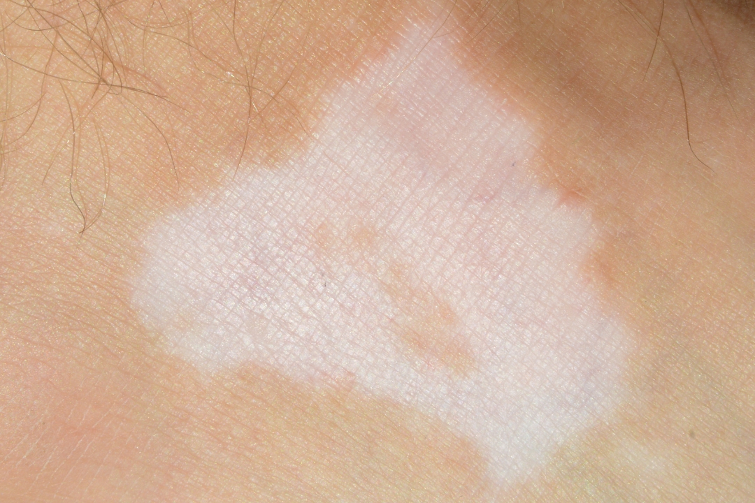 白斑(トータルスキンクリニック 天神大名院、松山院)