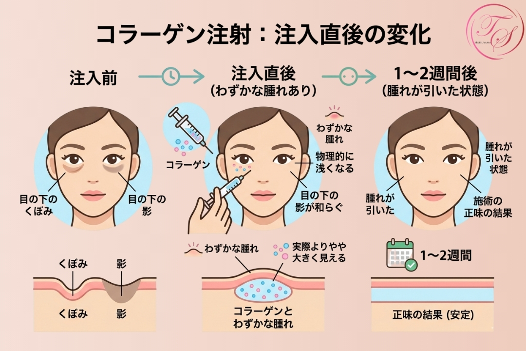 「コラーゲン注射：注入直後の変化」と題したインフォグラフィック。左から「注入前」、「注入直後（わずかな腫れあり）」、「1～2週間後（腫れが引いた状態）」の経過を正面顔と断面図で示している。注入前のくぼみと影が、コラーゲンと一時的な腫れで盛り上がり、最終的に腫れが引いて安定した結果となる様子を解説しています。（トータルスキンクリニック 福岡天神院）