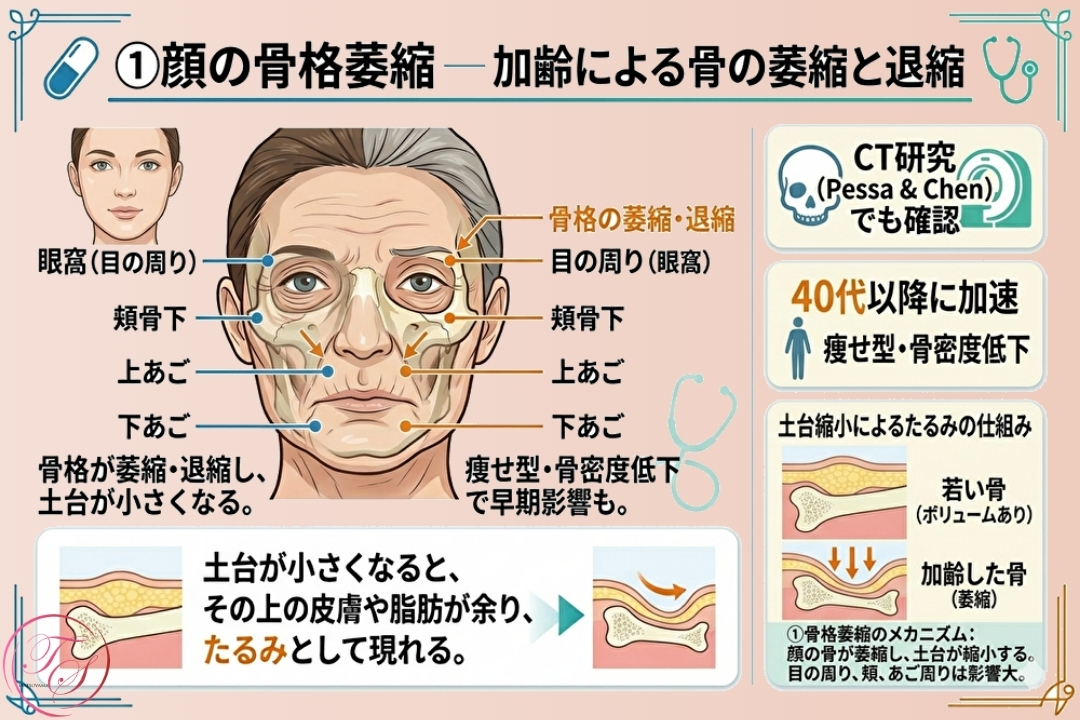 顔のたるみの原因となる「骨格の萎縮」の解説図。加齢により目の周り（眼窩）や頬、あごの骨が退縮し、土台が小さくなることで皮膚が余り、たるみが生じるメカニズムをCT研究データに基づき図解。（トータルスキンクリニック 福岡天神院）