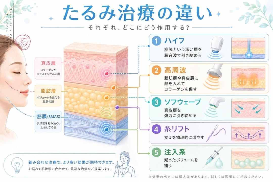 「ハイフ、高周波、ソフウェーブ、糸リフト、注入系治療の効果と作用する皮膚層を比較した、顔のたるみ治療インフォグラフィック」(トータルスキンクリニック 福岡天神院、松山院)