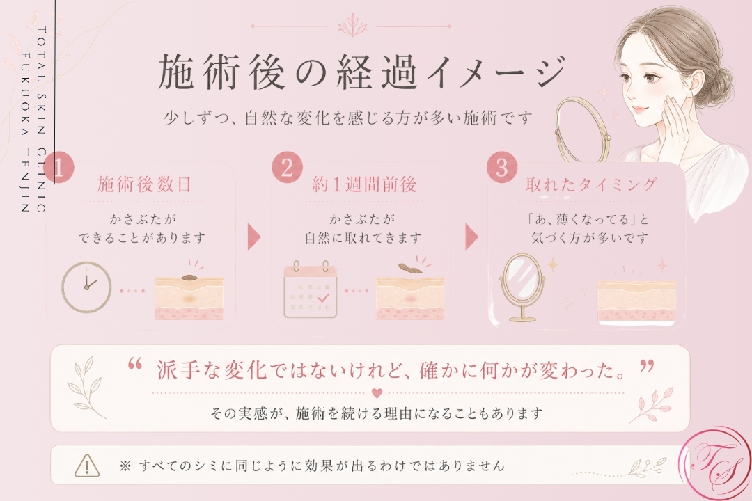 レーザー治療後のかさぶたが自然に取れるまでの経過と、シミが薄くなる変化を説明した美容クリニック向けインフォグラフィック(トータルスキンクリニック 福岡天神院）