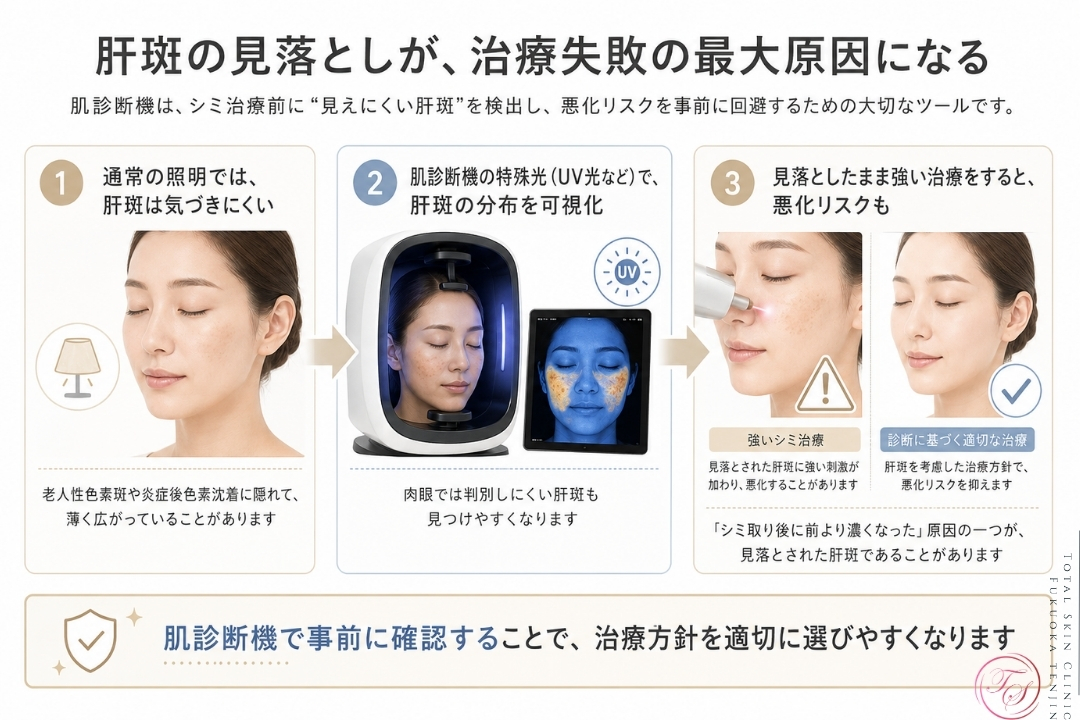 肝斑の見落としによるシミ治療の失敗リスクを、肌診断機の特殊光で事前に確認し、適切な治療方針を選ぶ流れを示したトータルスキンクリニック福岡天神院のインフォグラフィック。