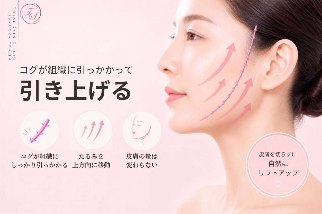 糸リフトは、糸に付いたコグが皮下組織に引っかかることで、たるんだ皮膚や脂肪を上方向へ移動させる治療ですが、皮膚の量自体は変わらないため、時間とともに後戻りが生じます。（トータルスキンクリニック 福岡天神院）