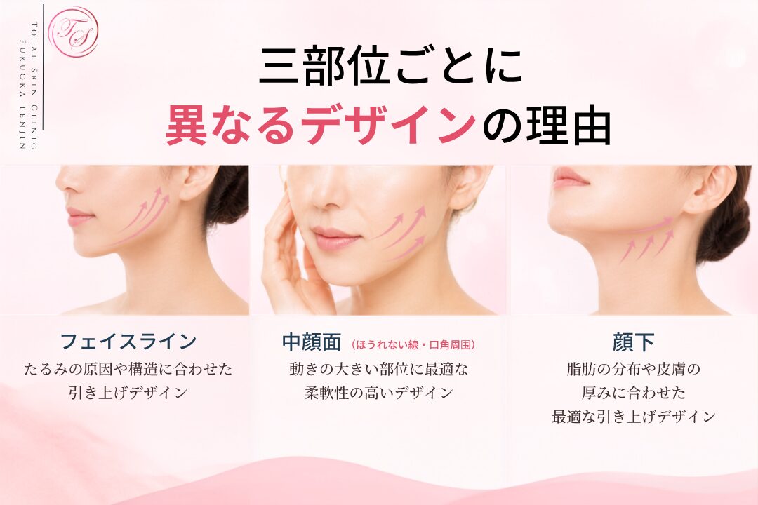 糸リフトは、フェイスライン・中顔面・顎下で解剖構造やたるみの原因が異なるため、トータルスキンクリニック福岡天神院ではそれぞれに適した糸の種類・挿入方向・固定方法を使い分けてデザインします。