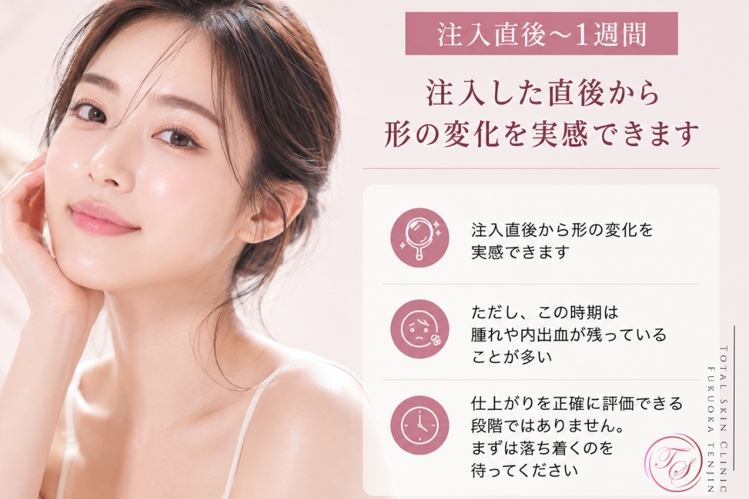 ヒアルロン酸注入直後〜1週間の経過として、形の変化を実感できる一方で、腫れや内出血が残りやすく、仕上がりの評価は落ち着いてから行う必要があることを解説した画像。(トータルスキンクリニック 福岡天神院)