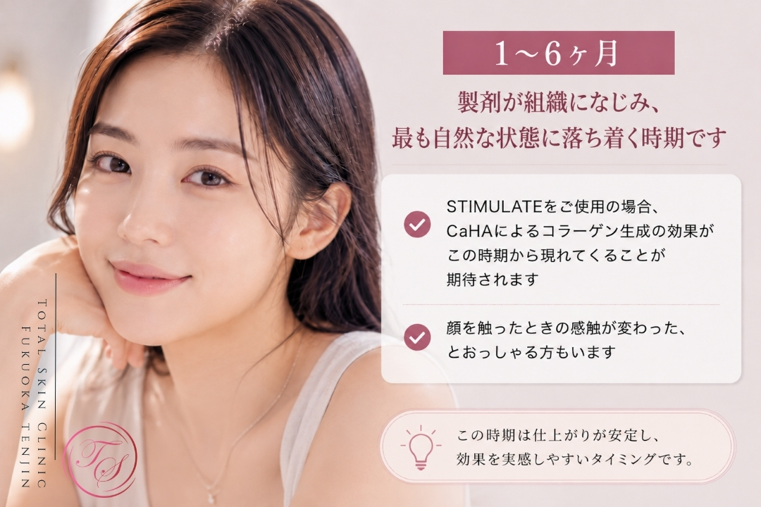 ニュービア注入後1〜6ヶ月の経過として、製剤が組織になじみ自然な仕上がりに落ち着く時期や、STIMULATE使用時のCaHAによるコラーゲン生成効果を解説した画像。(トータルスキンクリニック 福岡天神院)