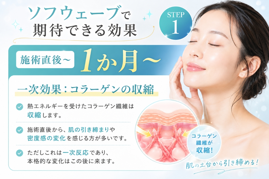 ソフウェーブ施術直後から1か月の一次効果を解説。熱エネルギーによるコラーゲン収縮と、肌の引き締まり・密度感の変化を紹介する美容医療インフォグラフィック(トータルスキンクリニック 福岡天神院)