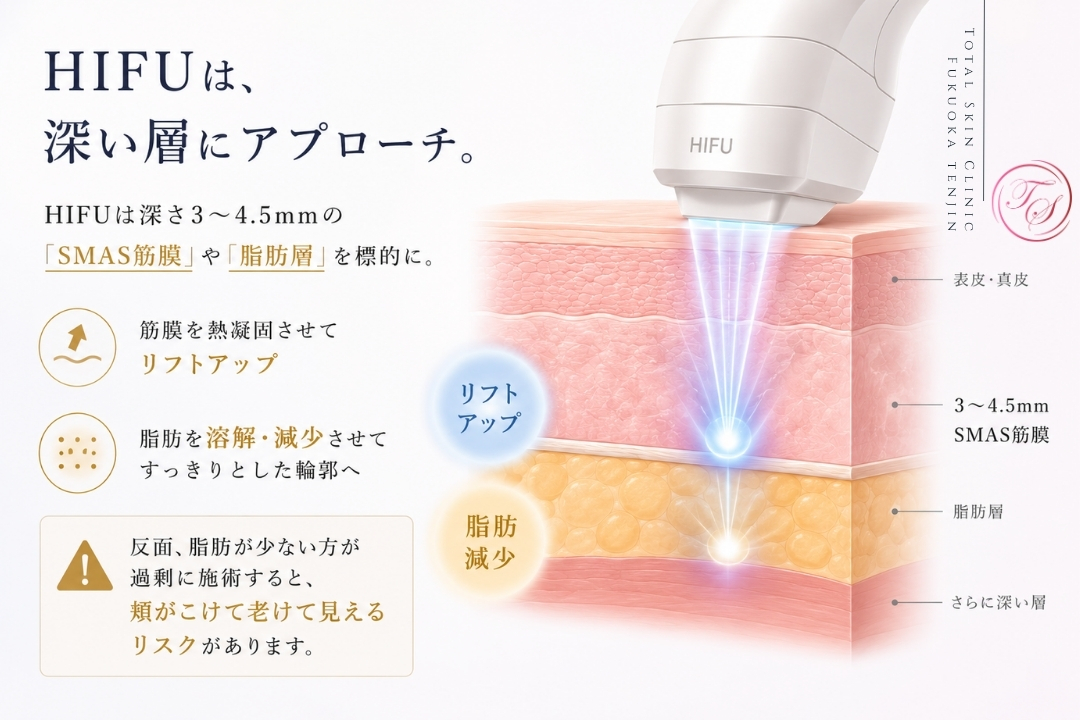 HIFUは深さ3〜4.5mmのSMAS筋膜や脂肪層を加熱してリフトアップや脂肪減少を目指す治療ですが、脂肪が少ない方への過剰照射は頬こけのリスクがあります。(トータルスキンクリニック 福岡天神院)