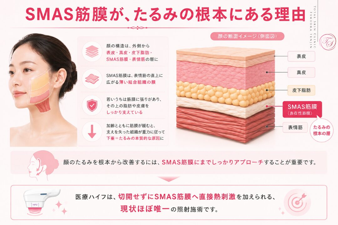 SMAS筋膜の緩みが皮膚や脂肪の下垂を招き、顔のたるみにつながる仕組みと、医療ハイフが切開せずにSMAS筋膜へ熱刺激を届ける理由を解説する、トータルスキンクリニック 福岡天神院の美容医療画像。