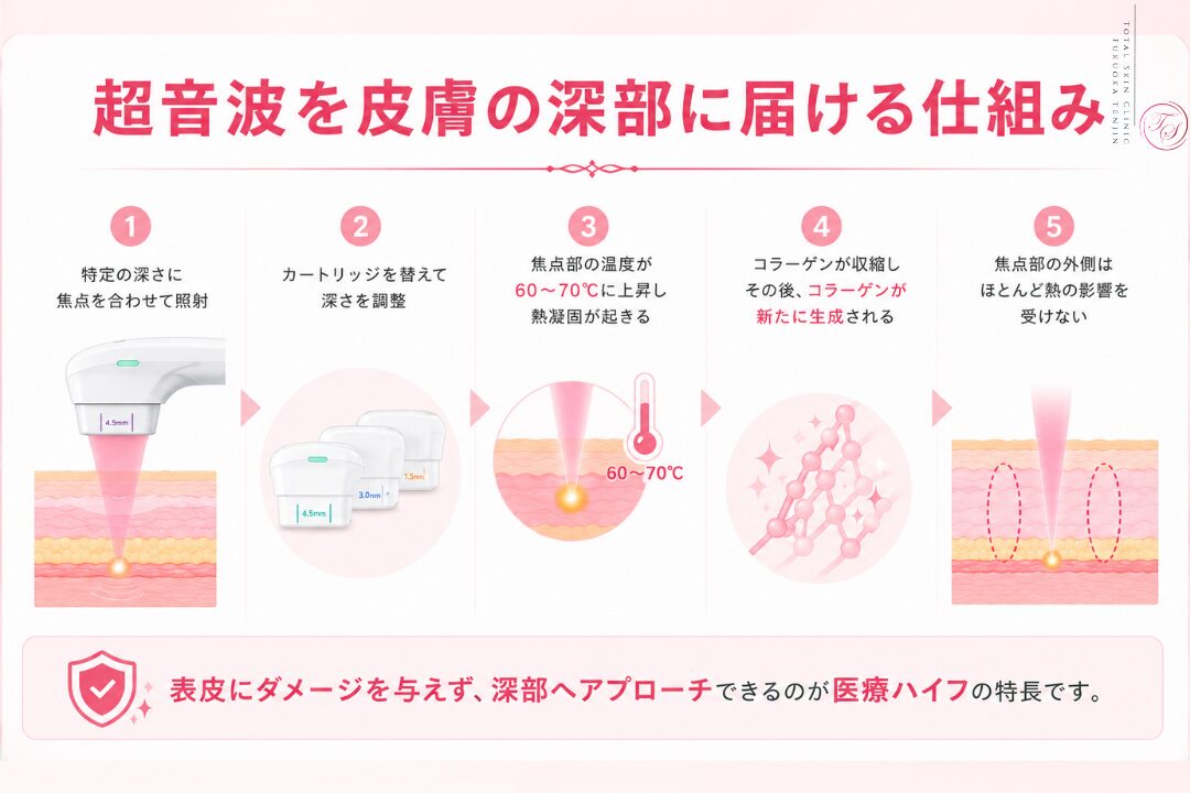 医療ハイフが超音波を皮膚深部の狙った位置に集中させ、約60〜70℃の熱でコラーゲンの収縮と再生を促す仕組みを紹介する、トータルスキンクリニック 福岡天神院の美容医療画像。